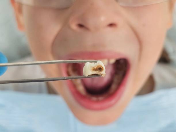 Best Emergency Tooth Extraction in Brookmont, MD
